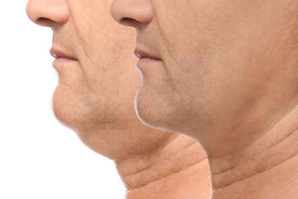 HIFU - Breakthrough in Anti - ageing 2 hifu results Hassocks
