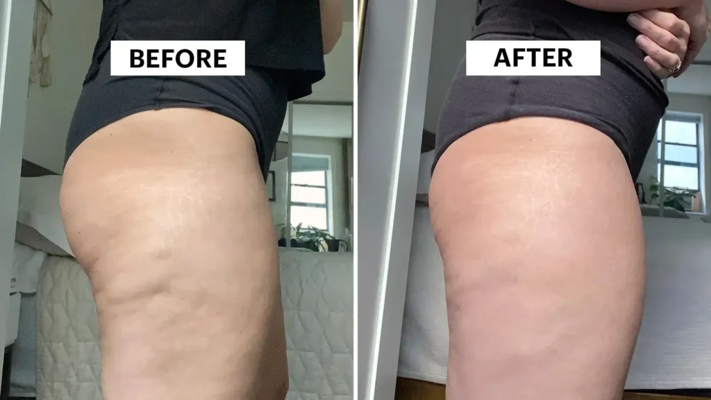 Sculpting Your Bum: Can Toning Exercises Really Reduce Cellulite? 1 Do Toning Exercise Hassocks Really Tackle Cellulite?
