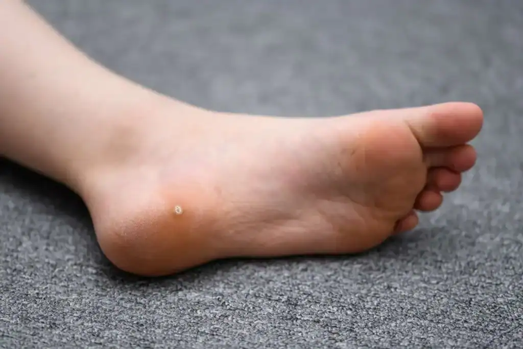 Cryotherapy For Warts And Also Verrucas 2 Image of verruca on the bottom of the foot that able to be treated with Cryotherapy Hassocks