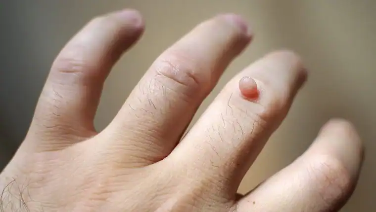 Image of blemish that Cryotherapy Hassocks can remove with Lipo 360.