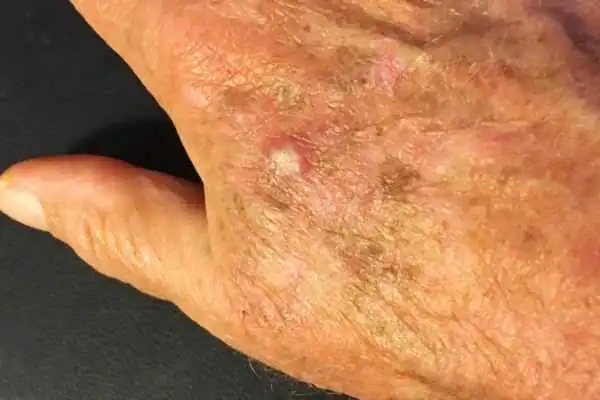 Image of Actinic keratoses Hassocks on a person hand