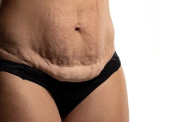 The science behind skin tightening Hassocks picture of a woman's sagging skin on the stomach